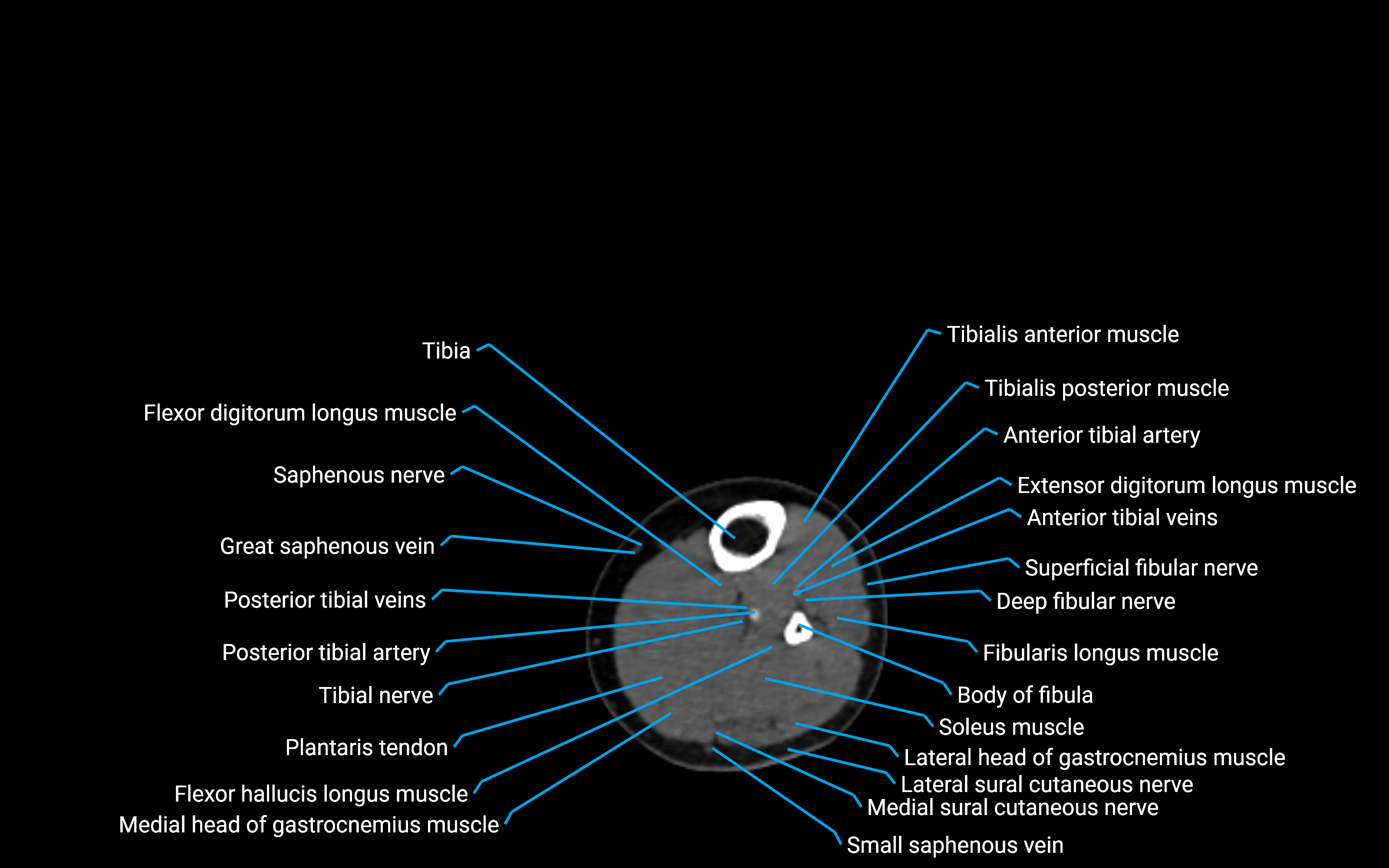 CT Lower leg axial cross sectional anatomy labelled image 110 (2).png